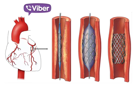 Cứu sống bệnh nhân bị nhồi máu cơ tim qua... Viber