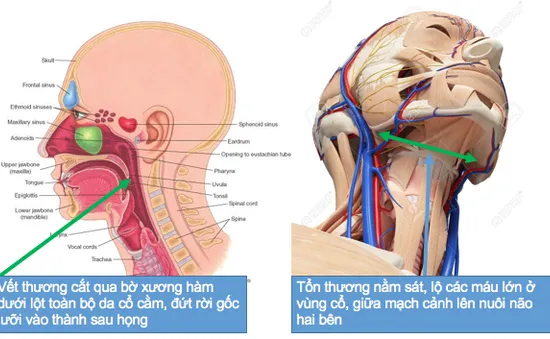 Sập giàn giáo, người phụ nữ phụ hồ bị xe rùa cắt gần đứt cổ