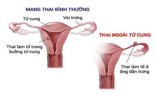 Phẫu thuật kịp thời một ca chửa kẽ hy hữu