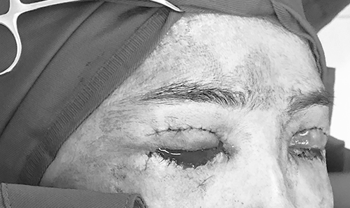 Máu chảy suốt 14 tiếng sau phẫu thuật cắt da thừa mi mắt ở thẩm mỹ tư nhân