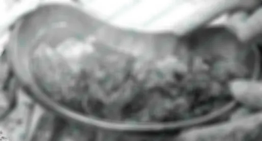 Người phụ nữ phải ngủ ngồi vì khối u trung thất nặng 2kg
