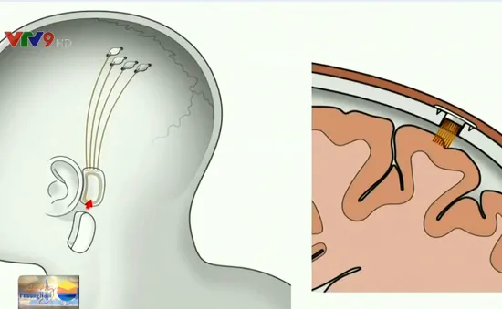 Tạo ra con chip gắn trong não người để kết nối với máy tính