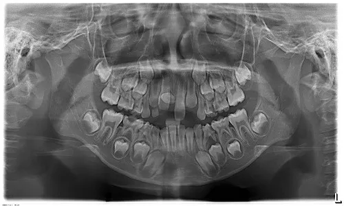 Cảnh giác rối loạn mọc răng vĩnh viễn ở trẻ em