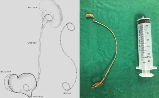 Bỏ quên 6 năm, sonde niệu quản gãy đoạn, bám đầy sỏi