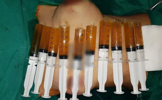 Ngực to như quả bóng, chực "phát nổ" sau khi đặt túi ngực