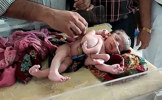 Bé gái sơ sinh có… 4 chân 4 tay ở Ấn Độ