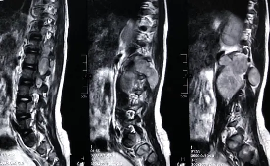 Hồi sinh đôi chân bị liệt cho bé gái 5 tuổi từng bị nhiều bệnh viện từ chối phẫu thuật