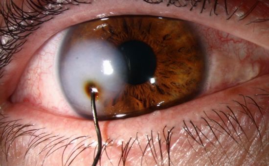 Suýt mù mắt vì mảnh kim loại đâm thủng mắt