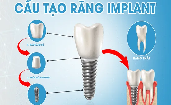 Chọn phương pháp trồng răng giả giá rẻ có an toàn hay không?