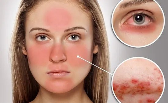 Chương trình nghiên cứu gene quy mô lớn về bệnh lupus ban đỏ tại châu Á