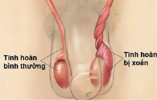 Đau tinh hoàn nhưng không viện điều trị, thiếu niên ở Quảng Ninh phải cắt tinh hoàn