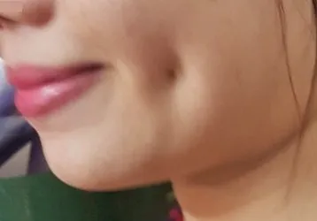 Tạo má lúm đồng tiền có nguy hiểm?