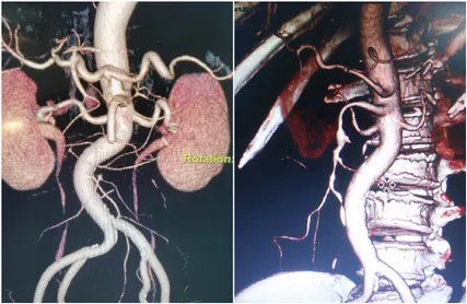 Giữ nguyên vẹn ruột cho bệnh nhân bị tắc hoàn toàn động mạch mạc treo hiếm gặp