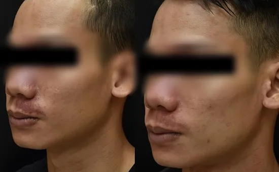 Làm gì khi bị bớt rượu vang
