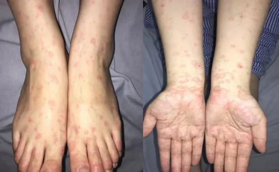 Làm sao để phòng ngừa Herpes sinh dục tái phát?