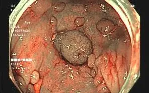 Cảnh báo bệnh nguy hiểm: Đa polyp trực tràng