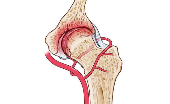 Hoại tử chỏm xương đùi - Căn bệnh nguy hiểm, diễn biến âm thầm