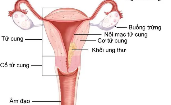 Quá sản nội mạc tử cung tiến triển thành ung thư vì không điều trị sớm