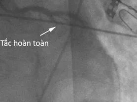 Cứu 2 bệnh nhân ngừng tuần hoàn hô hấp do nhồi máu cơ tim