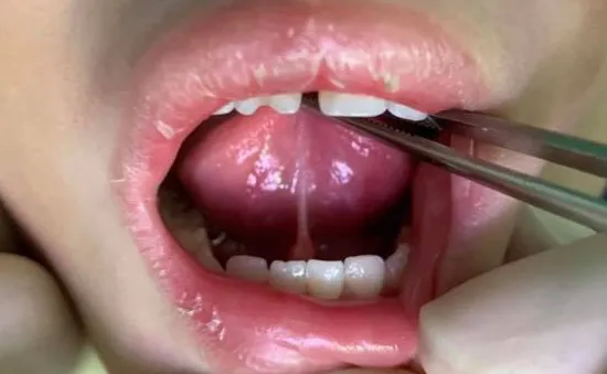 Dính thắng lưỡi - nguyên nhân khiến trẻ chậm nói