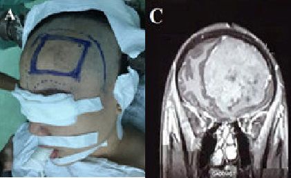 Nhập viện vì các triệu chứng tâm thần, cô gái trẻ phát hiện u màng não khổng lồ