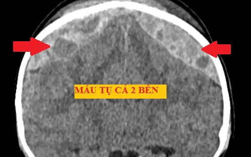 Cưa hộp sọ cứu bé trai xuất huyết não do ngã giường tầng