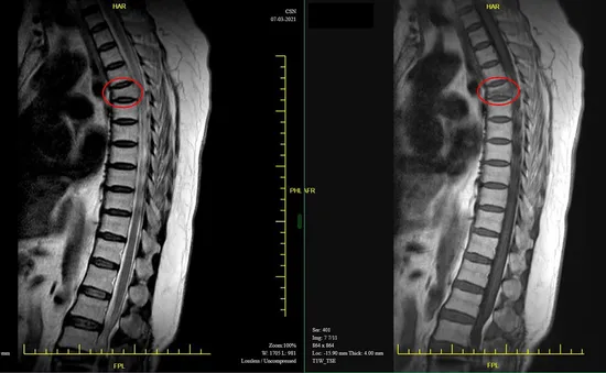 Bơm xi măng điều trị cho bệnh nhân xẹp đốt sống do ngã đập lưng trên sàn cứng