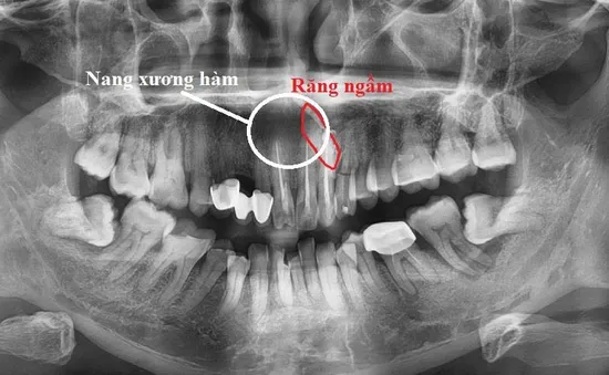 Sưng đau môi trên lâu ngày: Cẩn trọng có thể bạn mắc u xương hàm