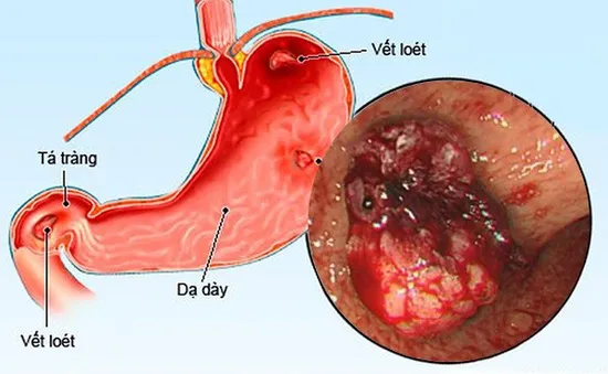 Phụ thuộc corticoid - bài học đắt giá