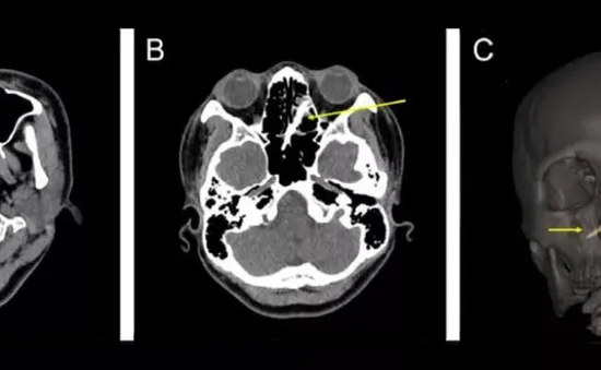 Hy hữu: Suýt chết do mảnh đũa nằm trong xoang mặt không được phát hiện trong một tuần