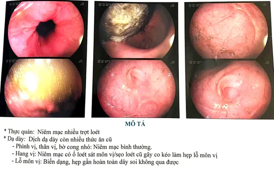 Bé 5 tuổi uống nhầm axit của bình ắc quy