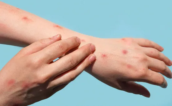 Virus đậu mùa khỉ lây truyền 4 ngày trước khi các triệu chứng bệnh xuất hiện