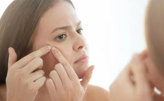 Mẹo nặn mụn hiệu quả mà không để lại thâm sẹo