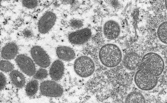 Cảnh báo virus đậu mùa khỉ có thể đã âm thầm lây lan
