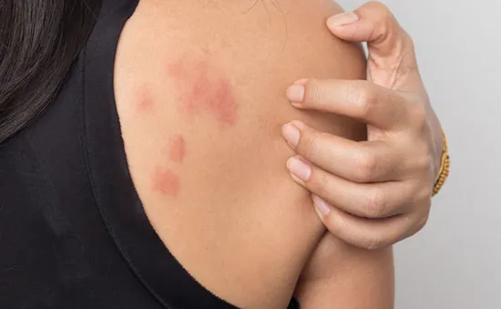 Nghiên cứu mới: Chất xơ trong ruột có thể giúp ích cho các bệnh về dị ứng da