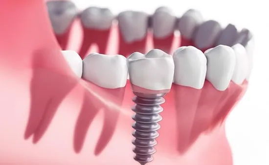 Trước khi thực hiện Implant cần lưu ý những vấn đề gì?