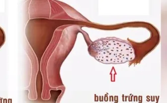 Gia tăng phụ nữ bị suy buồng trứng