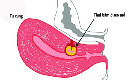 Cẩn trọng với thai bám ở sẹo mổ cũ