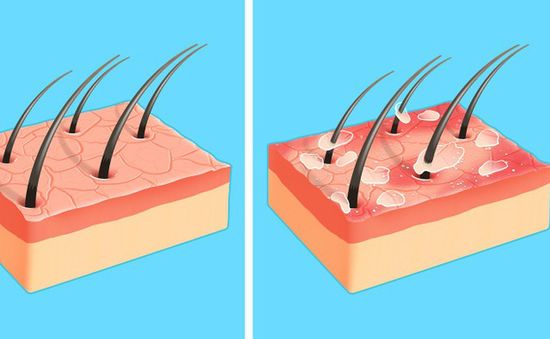 Tại sao da đầu lại có gàu và có cách loại bỏ nó không?