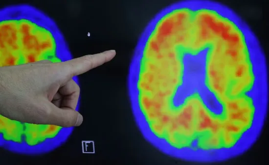 Mỹ xây dựng cơ sở dữ liệu trị giá 300 triệu USD thúc đẩy nghiên cứu về bệnh Alzheimer