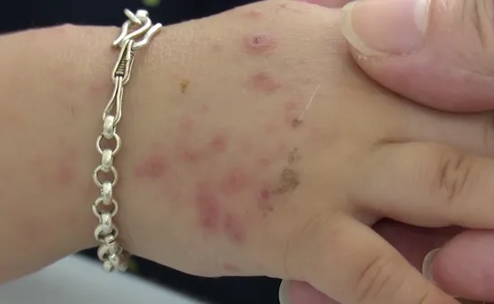 Bệnh tay chân miệng đang vào mùa - Cha mẹ lưu ý để bệnh không trở nặng