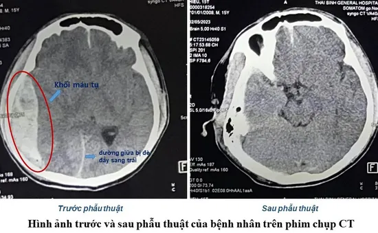 Lãnh đạo bệnh viện ký giấy mổ cứu sống bệnh nhân bị tai nạn giao thông khi không có người nhà