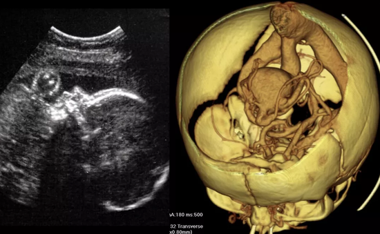 Ca phẫu thuật não đầu tiên trên thai nhi trong bụng mẹ được thực hiện
