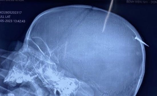 Phẫu thuật kịp thời cho bé trai bị cây đinh dài 3cm đâm qua xương sọ