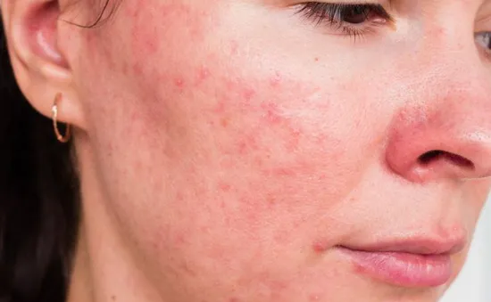 10 tình trạng về da phổ biến nhất bạn cần biết