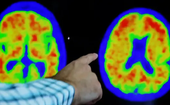 Thêm loại thuốc hứa hẹn làm chậm quá trình Alzheimer