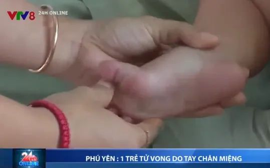 Phú Yên: 1 trẻ bị tử vong do bệnh tay chân miệng