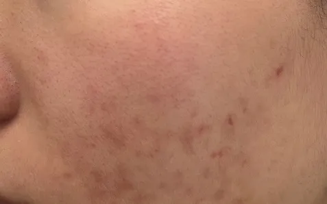 "Peel da" - có nên thực hiện tại nhà?