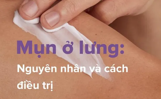 Mụn ở lưng: Nguyên nhân và cách điều trị