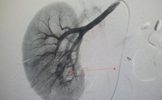 Nút mạch điều trị dị dạng mạch thận hiếm gặp